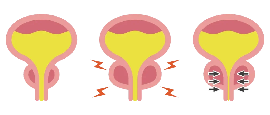 מהי ערמונית מוגדלת ומתי נבצע ניתוח להסרתה?