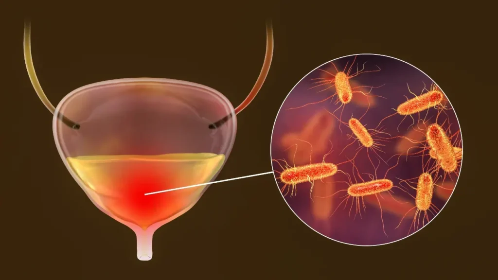 דלקת בדרכי השתן